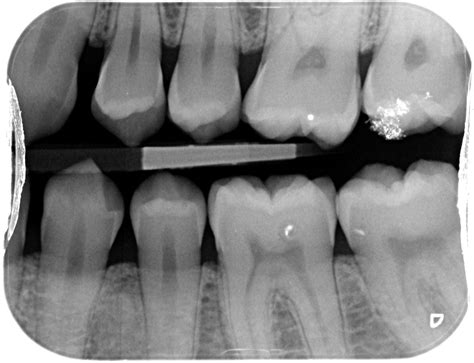 Discontinuity is a break in the test specimen’s structural continuity. . What is a radiograph